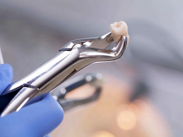 Удаление зуба: когда необходимо и как проводится?